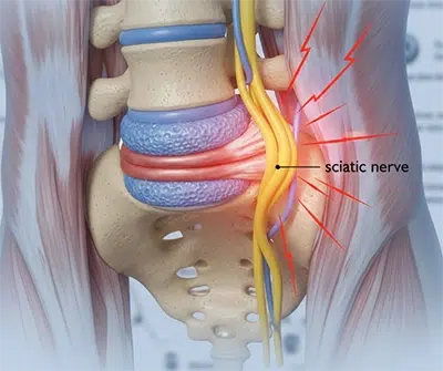 Chiropractor Traverse City MI Sciatic Nerve