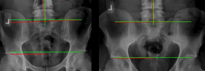 The Leaning Tower of You: Why One “Short Leg” Is Wrecking Your Spine in Traverse City MI (And How to Fix the Foundation)