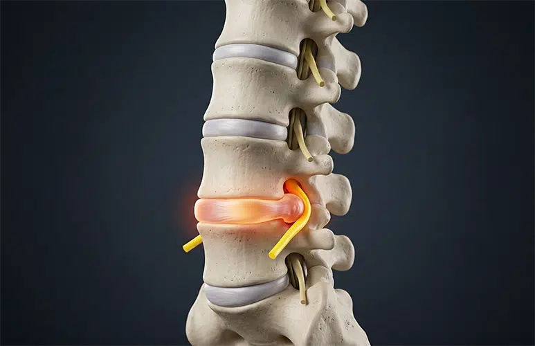Chiropractor Traverse City MI Spine Disc Injury
