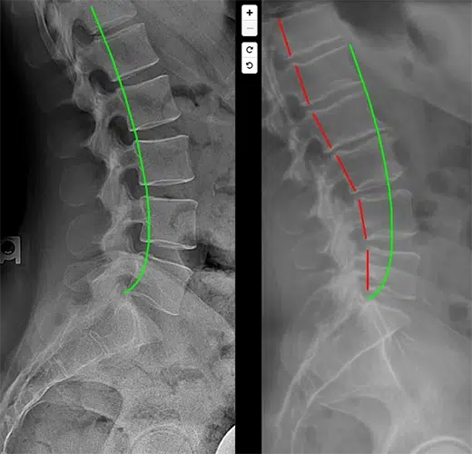 Chiropractor Traverse City MI X Ray