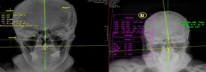 headache-xray-traverse-city-MI