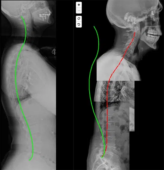 Chiropractic Traverse City MI Before and After X-Ray