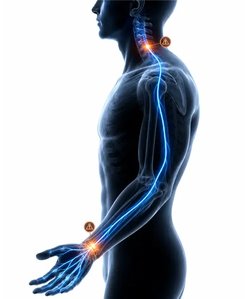 Chiropractic Traverse City Neck Pain Carpal Tunnel Diagram