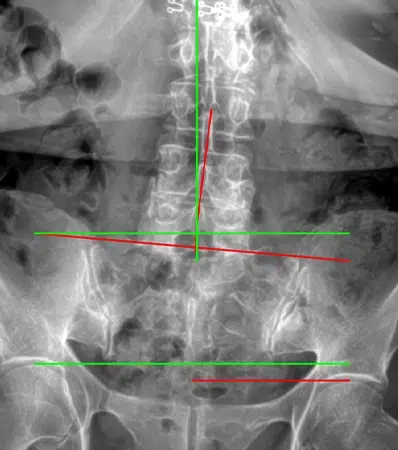 Chiropractic Traverse City MI X-ray