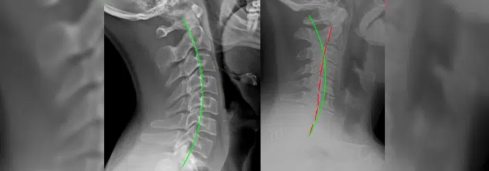 Cervicogenic Headache in Traverse City MI: When Your Headache Starts in Your Neck