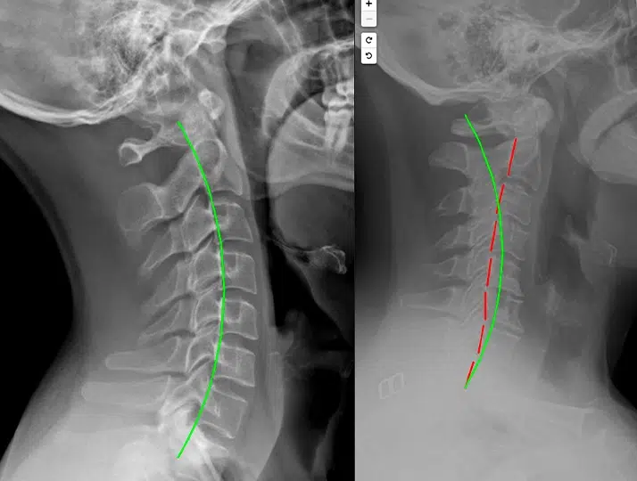 Side-by-side cervical spine X-rays comparing neck alignment and curvature, with colored lines illustrating differences in cervical posture and spinal curve.
